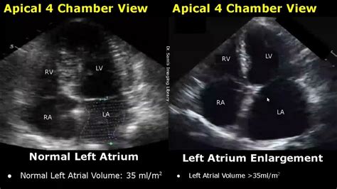 normal 2d echo result|Understanding Normal vs Abnormal Echocardiogram Results.